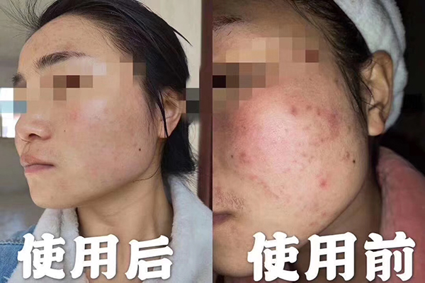祛痘廠(chǎng)家:祛痘護(hù)膚品的成分解析-歐泉生化